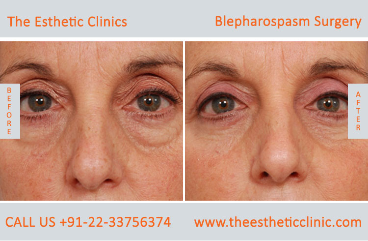 Blepharospasm Treatment, Eyelid Treatment before after photos in mumbai india (2)